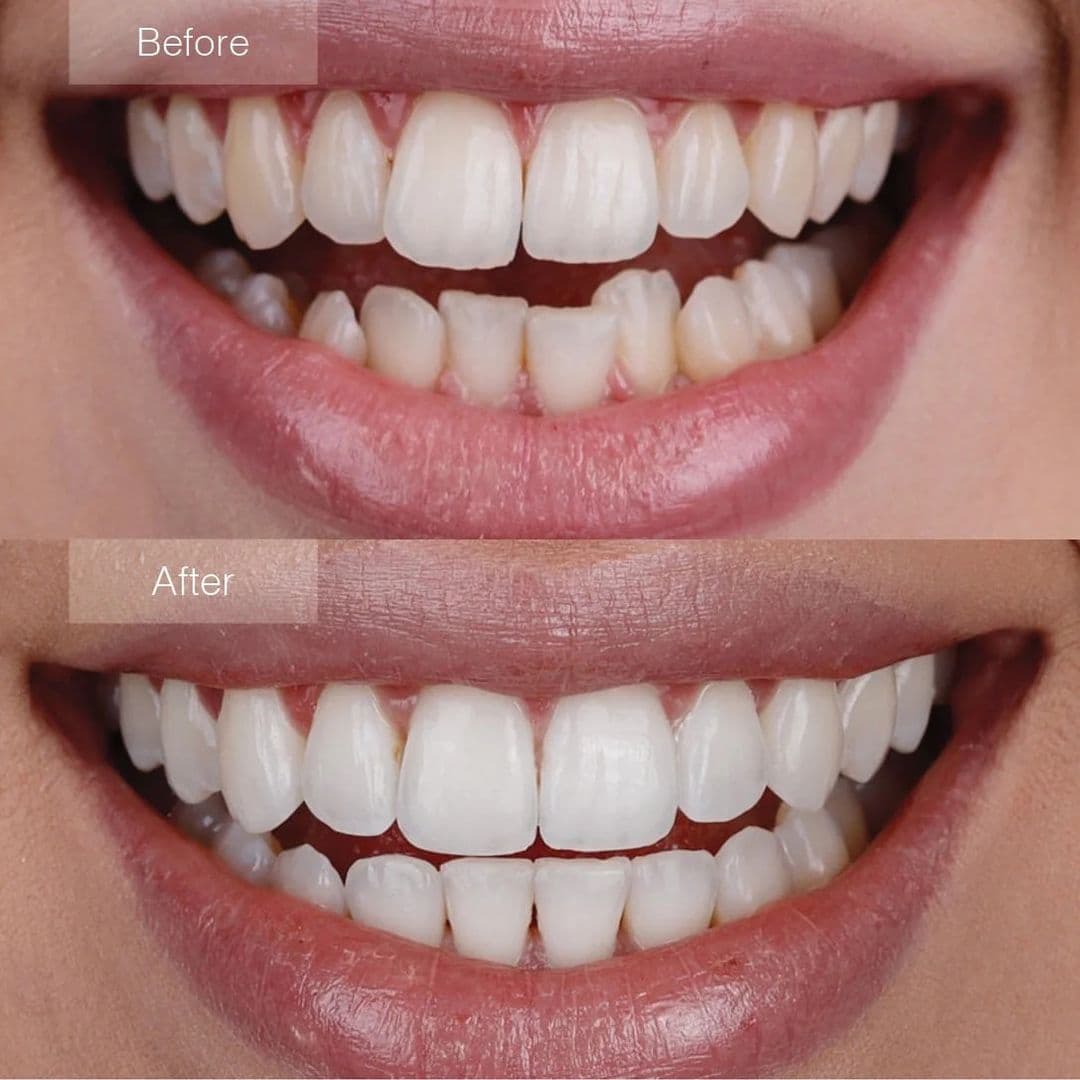 Reveal dental cover photo